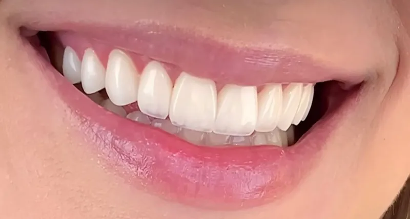 Sonrisa con carillas